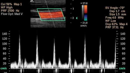 Jedno z využití Dopplerova efektu - ultrazvuková diagnostika žilních onemocnění dolních končetin