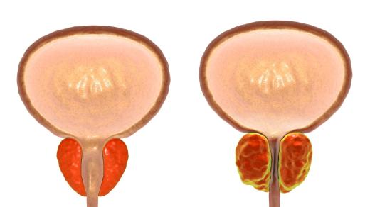 Prostata, normální a zvětšená (ilustrační foto)